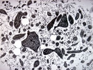 M,18y. | megamitochondria - Wilson disease M,18y. | megamitochondria - Wilson disease